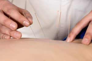 acupuncture img 1